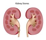 Dealing with Kidney Stones