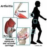 Causes And Treatments for Arthritis